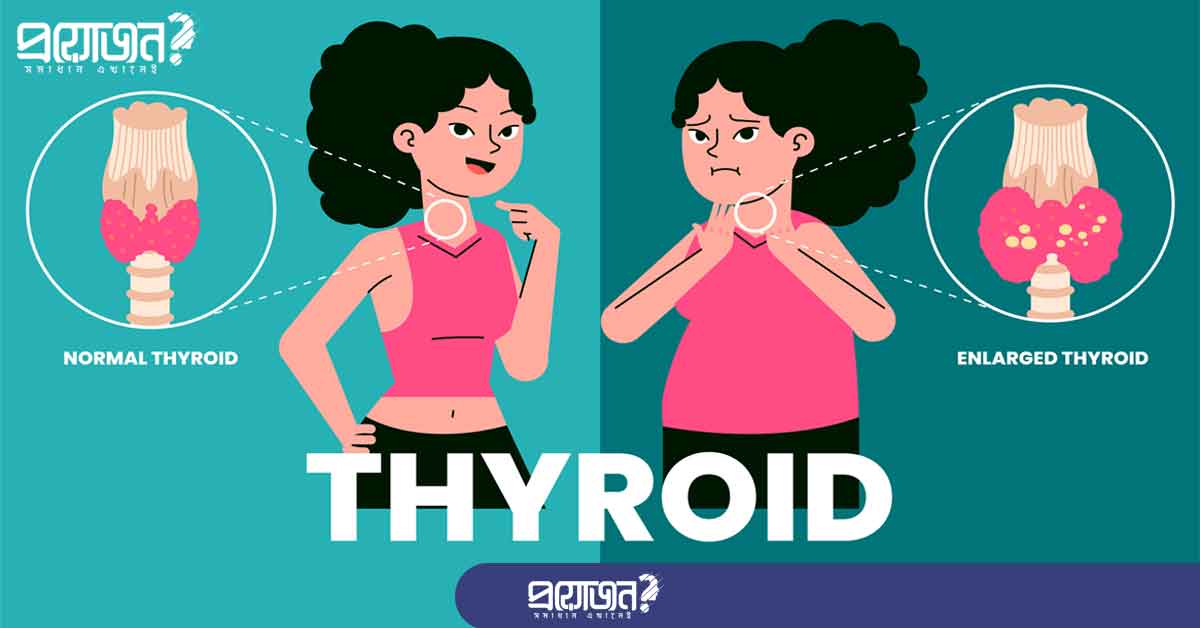 থাইরয়েড কমানোর উপায় Thyroid Problem