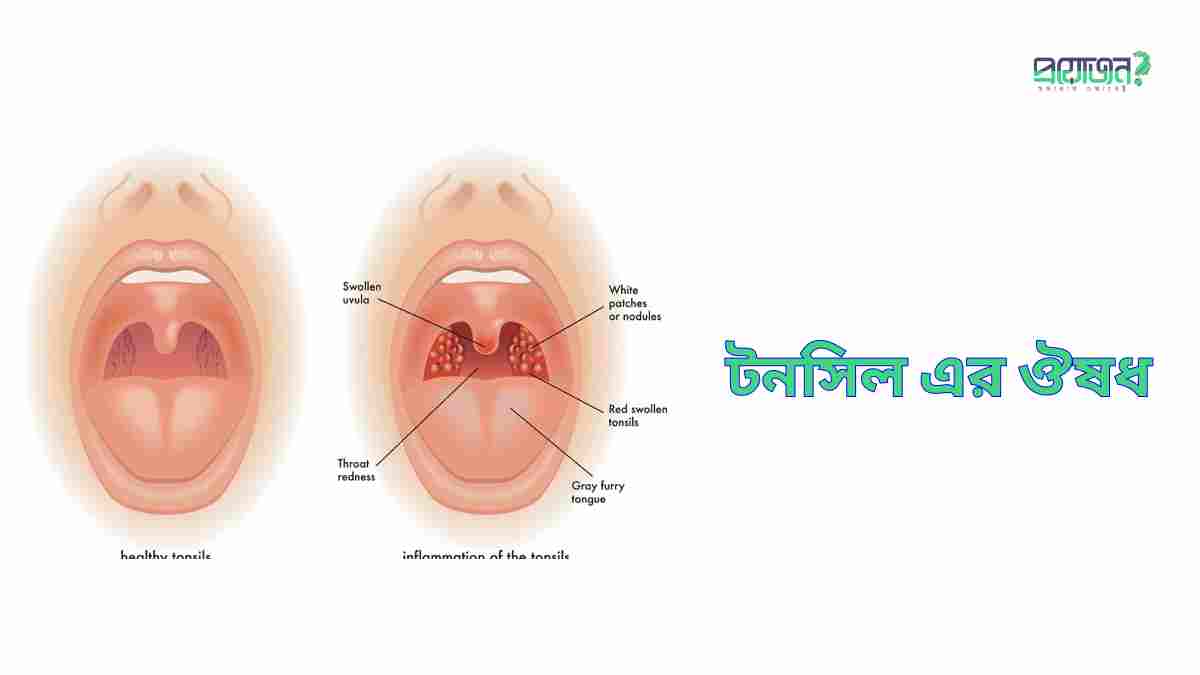 টনসিল এর ঔষধ Tonsil medicine