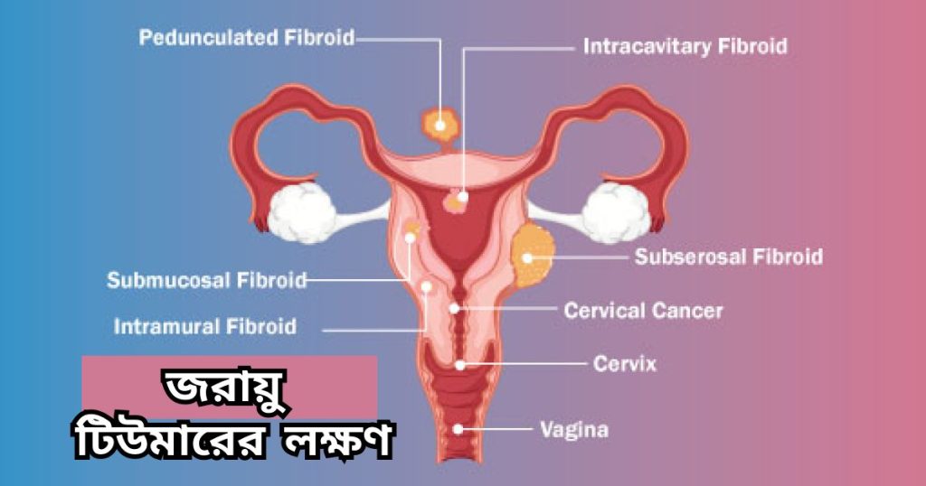 জরায়ু টিউমারের লক্ষণ uterus tumor